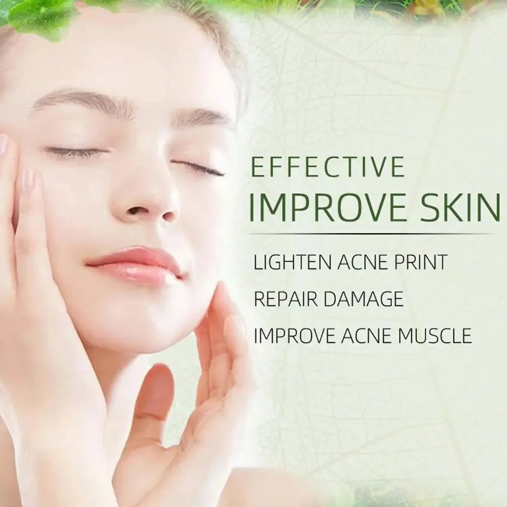 JoyPretty Herbal Acne Face Cream – Oil Control & Marks Removal