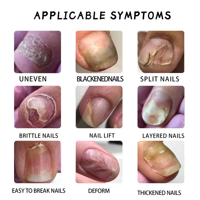 Ginger Nail Repair Serum – Restore Discolored & Uneven Nails