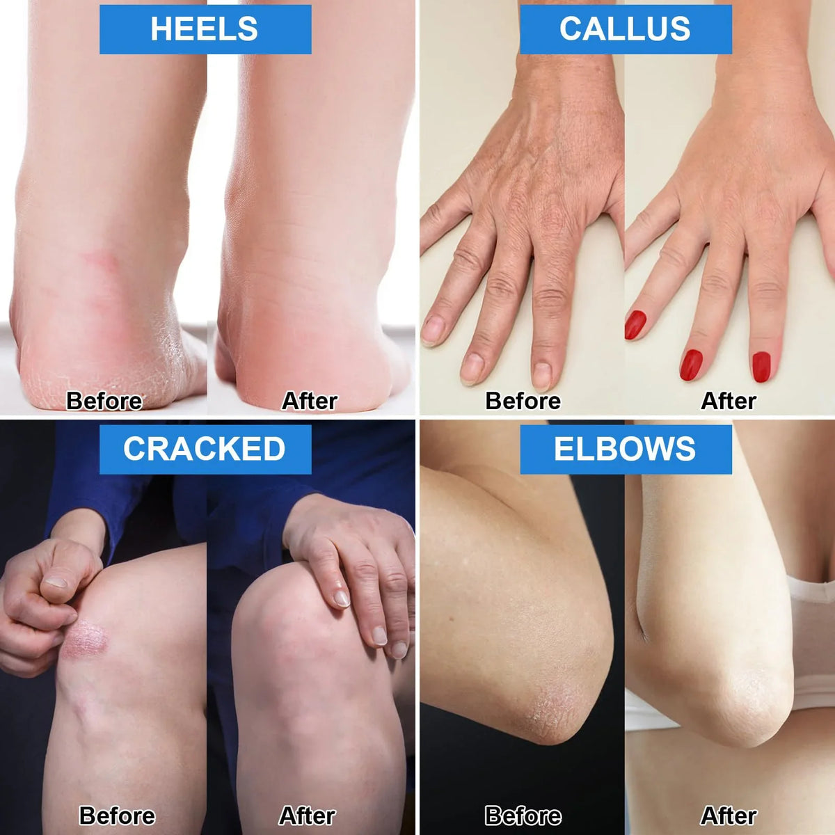Urea Cream 42 Salicylic Acid 2 Lavender Foot Dry Cracked Heels