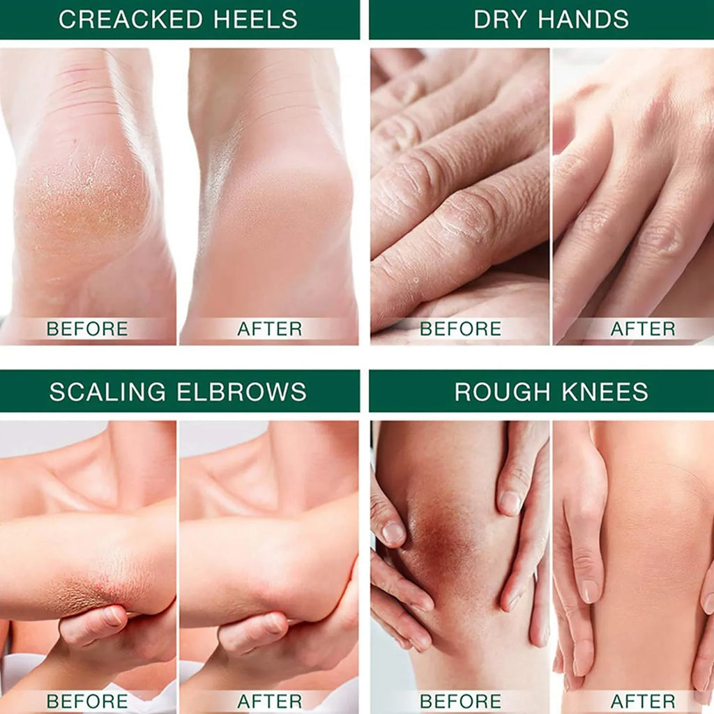 Urea Cream 42 Foot Dry Cracked Heels Percent Feet Moisturizing