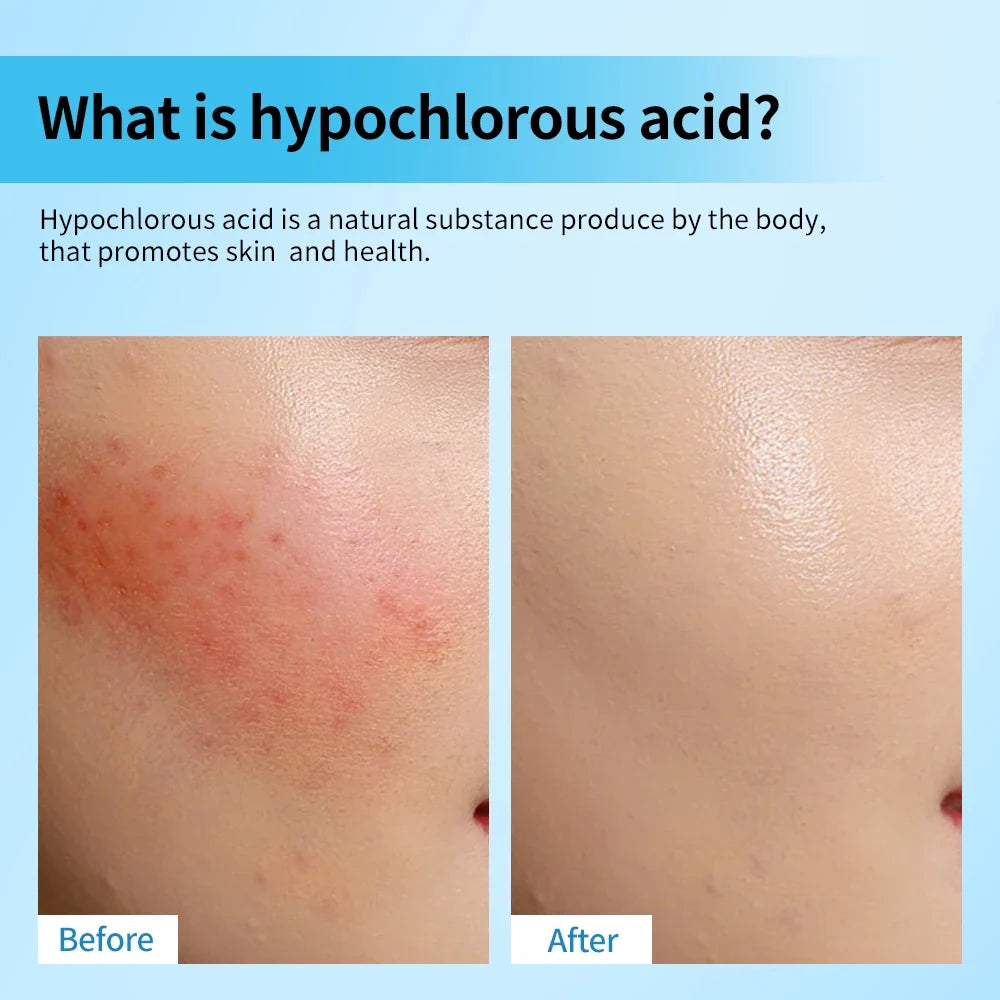 Hypochlorous Acid Facial Spray – Calm Redness & Acne | 65ml