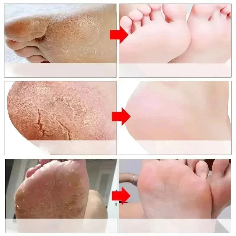LAIKOU Herbal Foot Cream Spray – Soften & Moisturize Heels