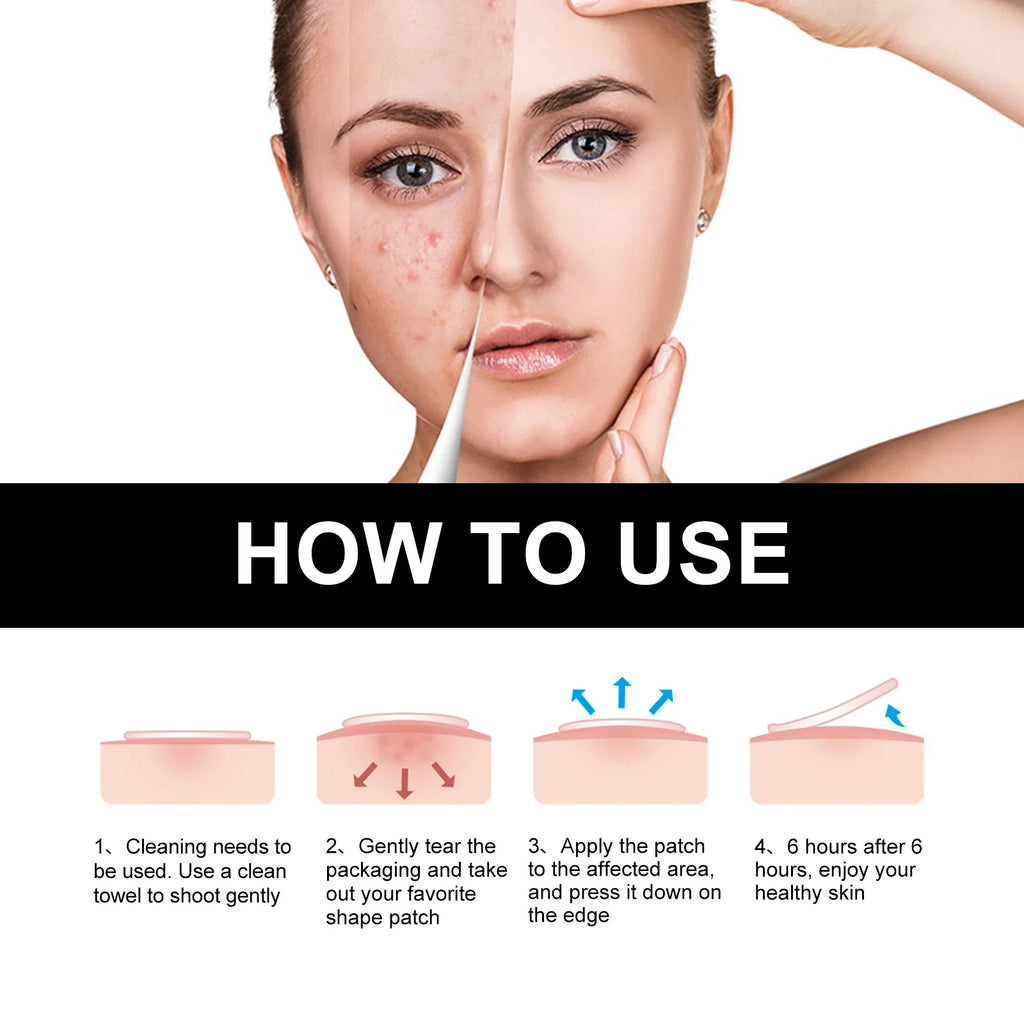 Hoygi Black Acne Patches – Spots, Blackheads & Skin Tone