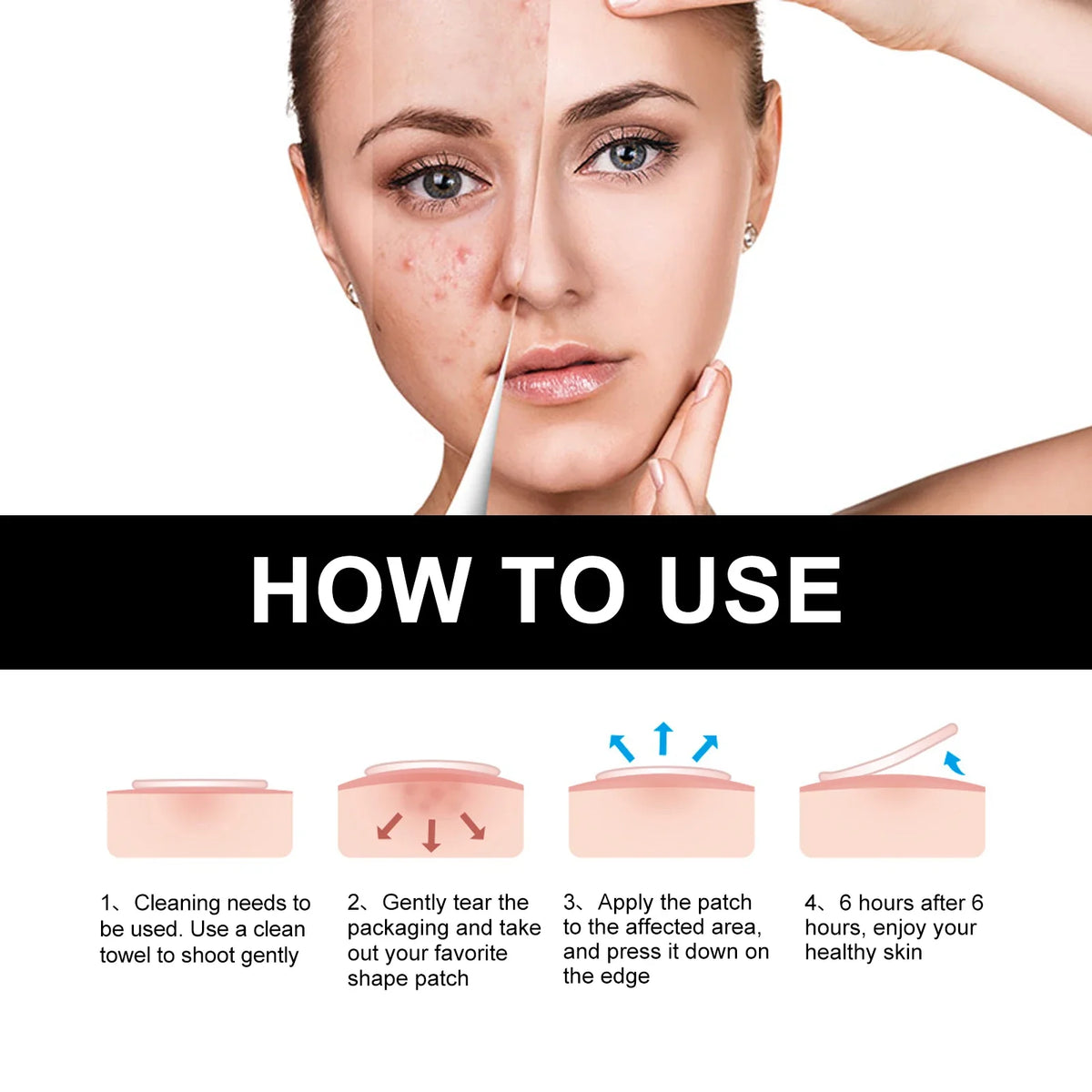 Hoygi Black Acne Patches – Spots, Blackheads & Skin Tone