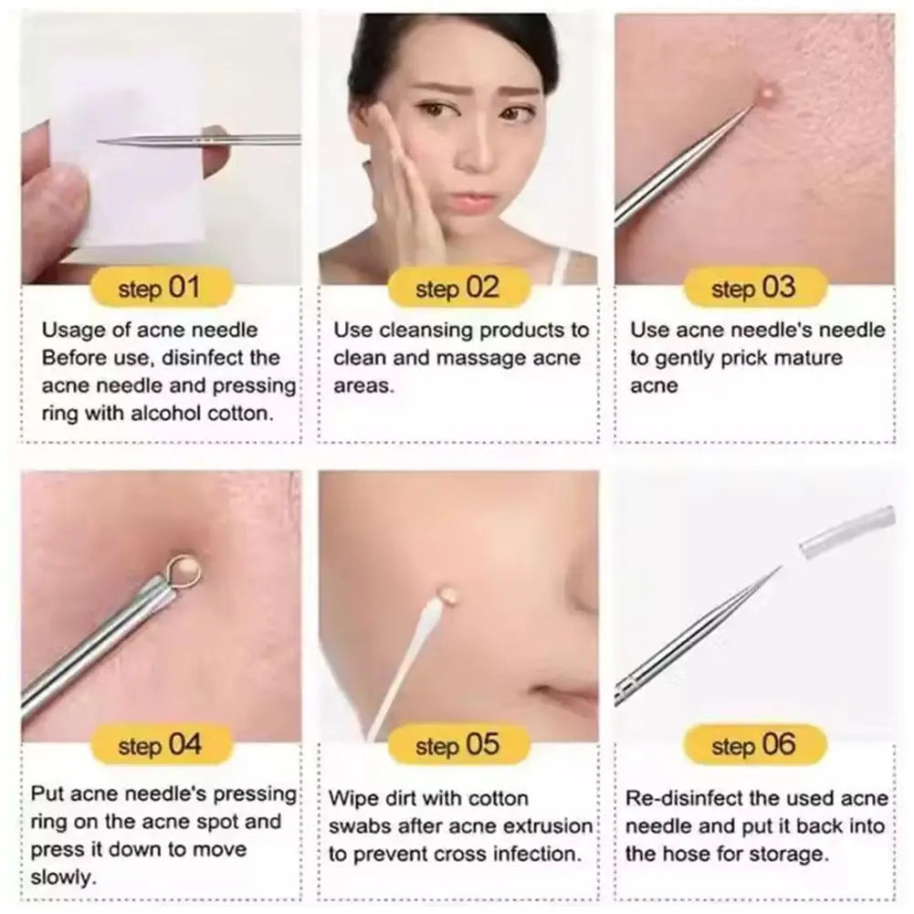 4-Piece Blackhead Remover Tool Set – Stainless Steel Acne Kit