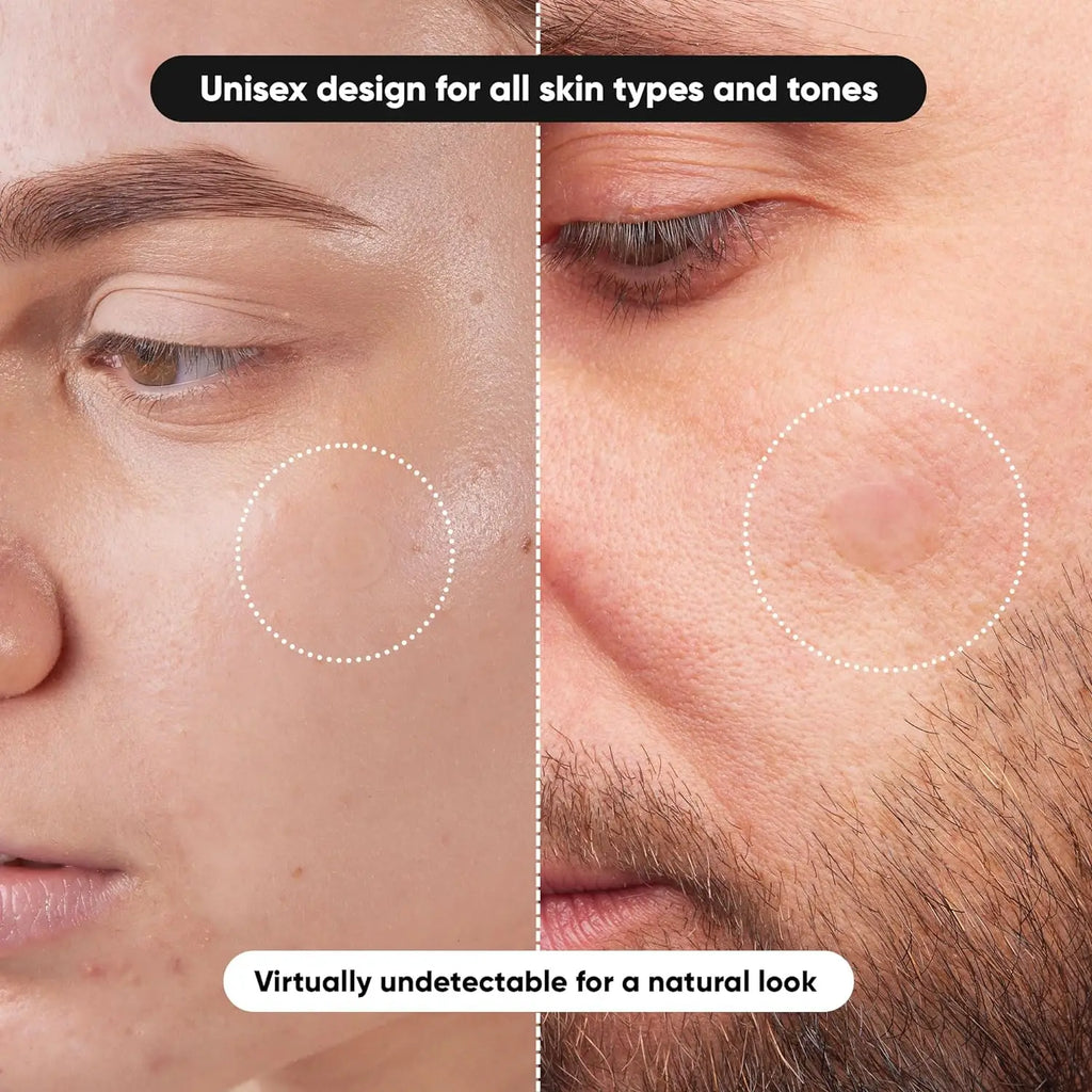 Hydrocolloid Acne Patches 360pcs – Invisible & Waterproof