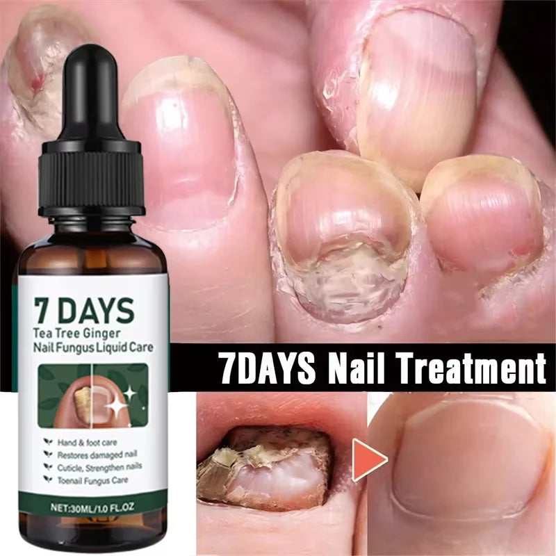 Ginger Nail Repair Serum – Restore Discolored & Uneven Nails