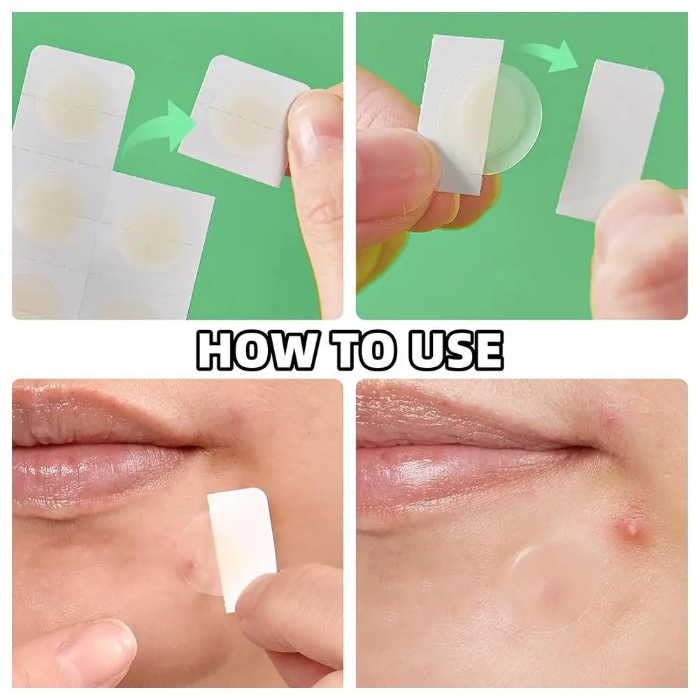 24-Pack Microneedle Acne Patches – Invisible & Waterproof