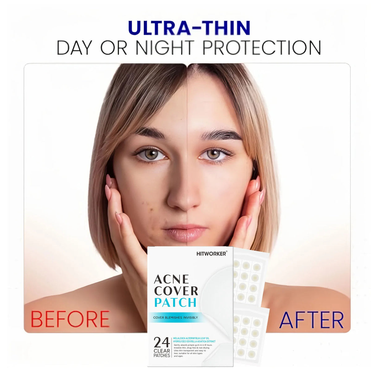 Hydrocolloid Acne Patches 24-Pack – Alcohol-Free Blemish Stickers