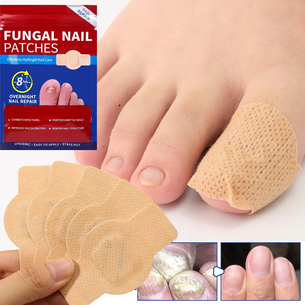 Nail Repair Patches – Toenail Care & Ingrown Correction Stickers