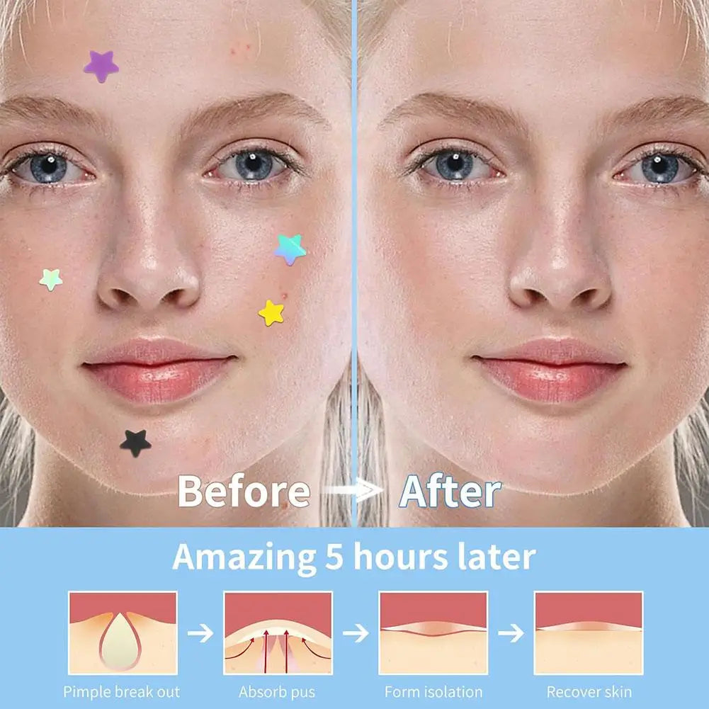 Colorful Star & Heart Hydrocolloid Acne Pimple Patches 168–252pc
